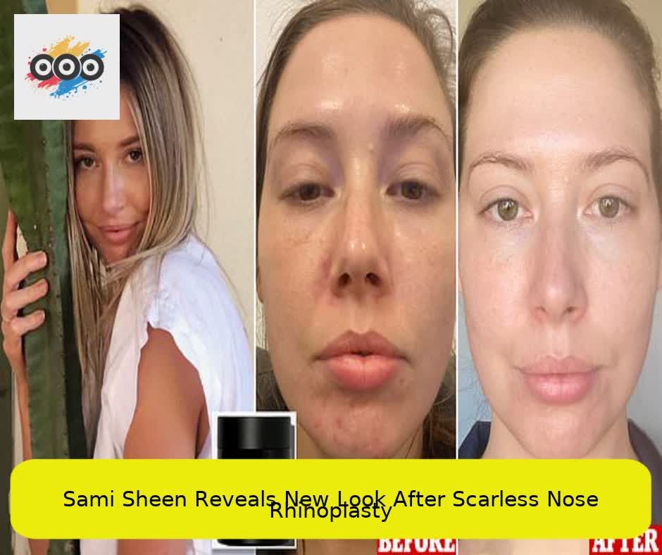 Sami Sheen Reveals New Look After Scarless Nose Rhinoplasty